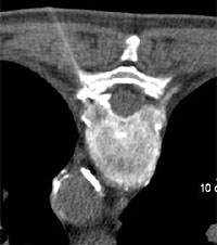 Treatment of nerve root (PRT) : CT guided injections : THERAPY